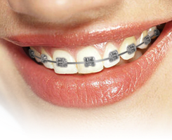 Braces Download Free PNG