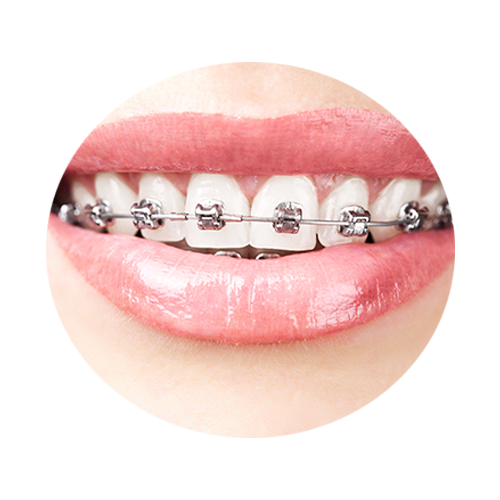 Braces PNG Pic Background