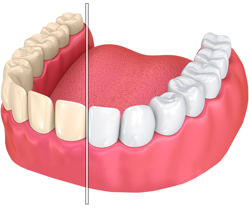 Dentures Transparent PNG